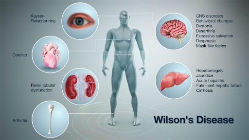 Bệnh Wilson – Chứng rối loạn chuyển hoá đồng