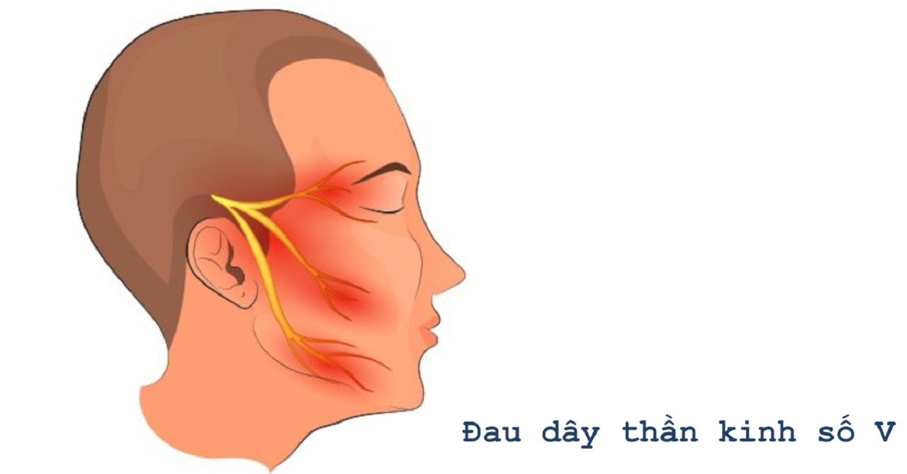 Đau dây thần kinh tam thoa