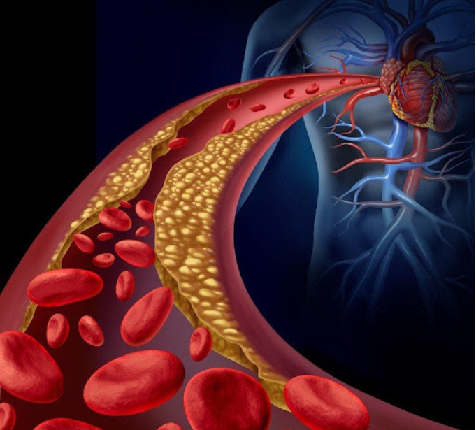Rối loạn lipid máu