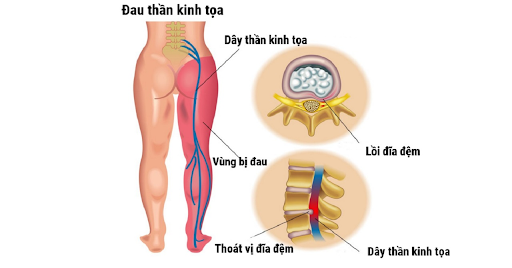 Đau thần kinh tọa
