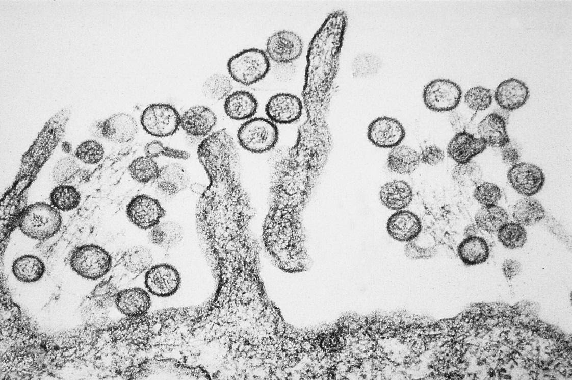 Sốt xuất huyết do virus Hanta