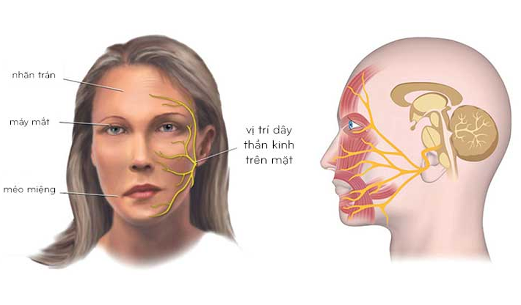 Liệt mặt ngoại biên