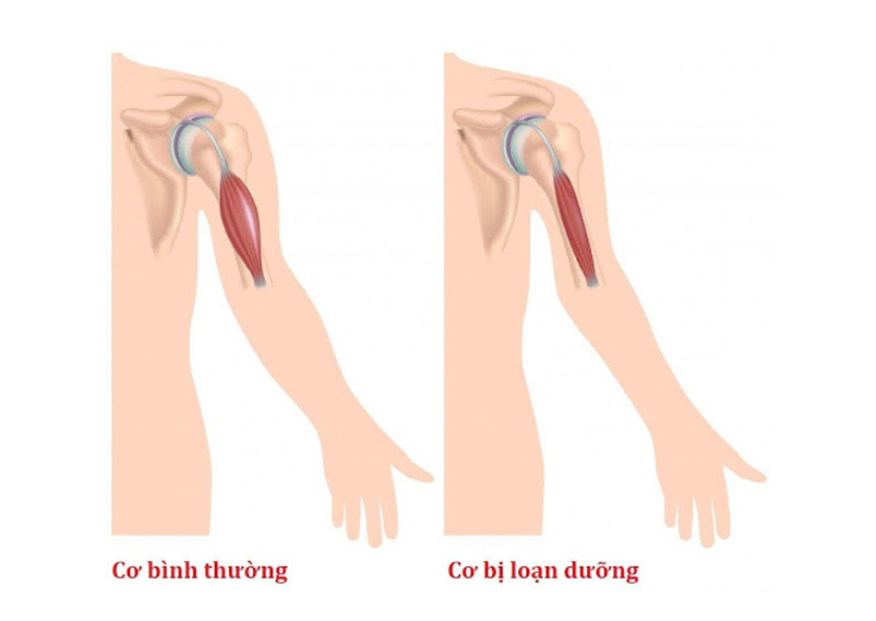 Loạn dưỡng cơ là gì? Nguyên nhân gây bệnh và nguyên tắc phòng ngừa