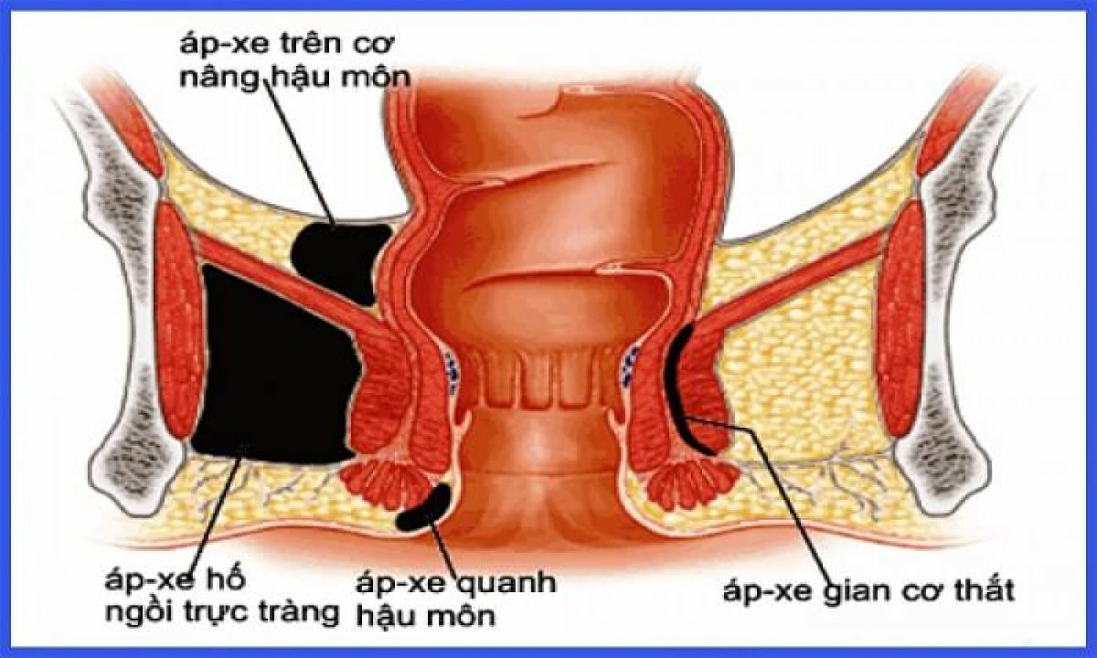 Áp-xe vùng hậu môn - trực tràng