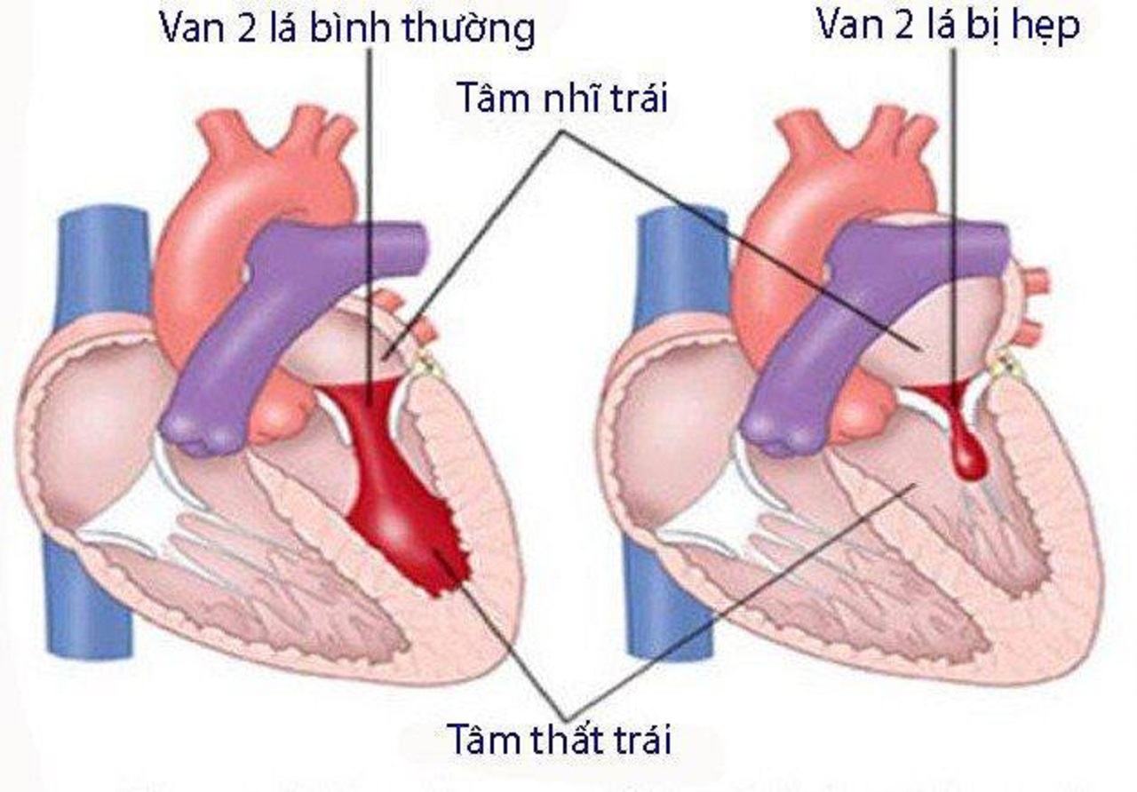 Hẹp van hai lá là gì? Nguyên nhân gây bệnh, phương pháp điều trị và nguyên tắc phòng ngừa