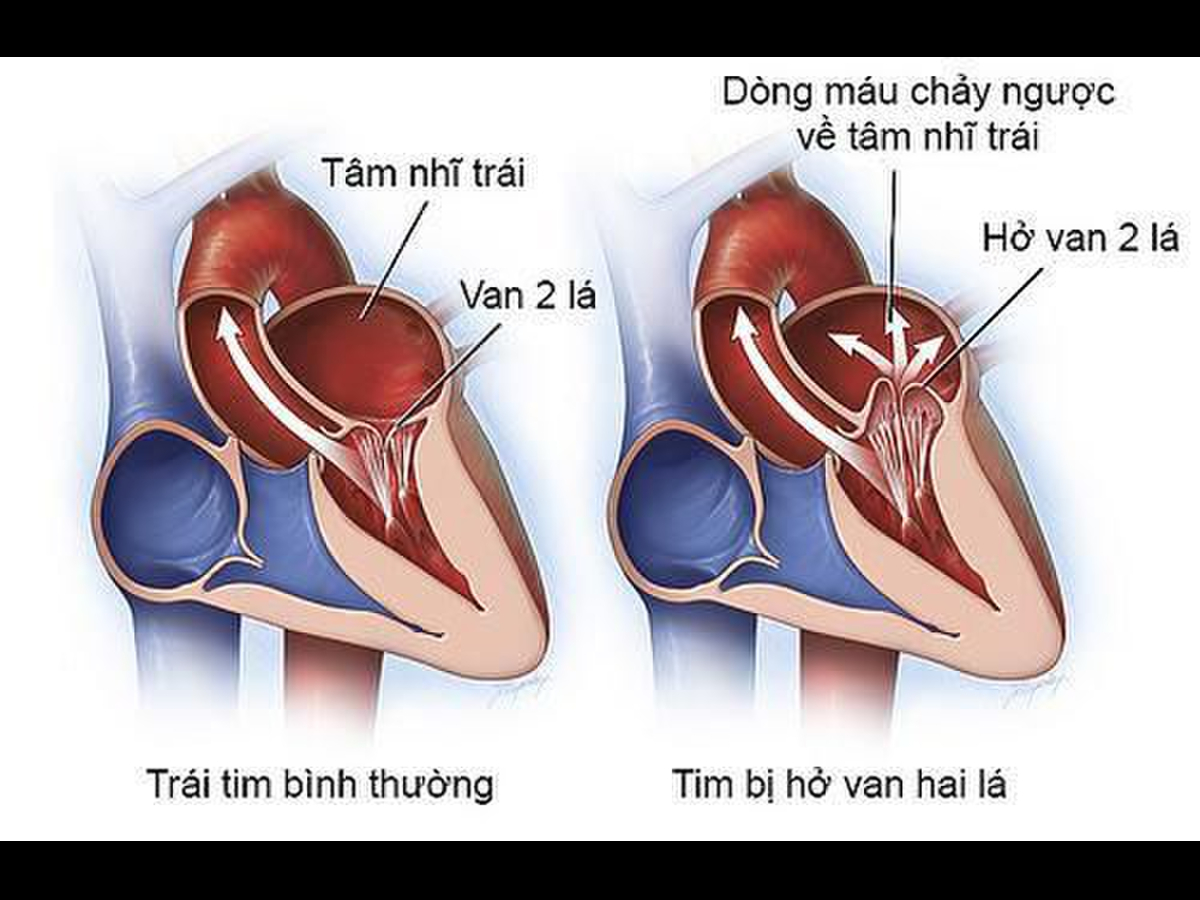 Hở van hai lá