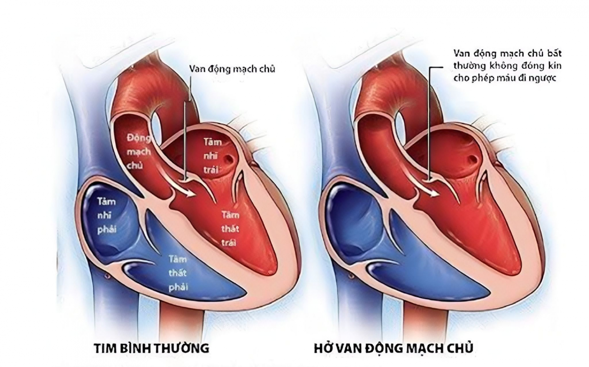Hở van động mạch chủ