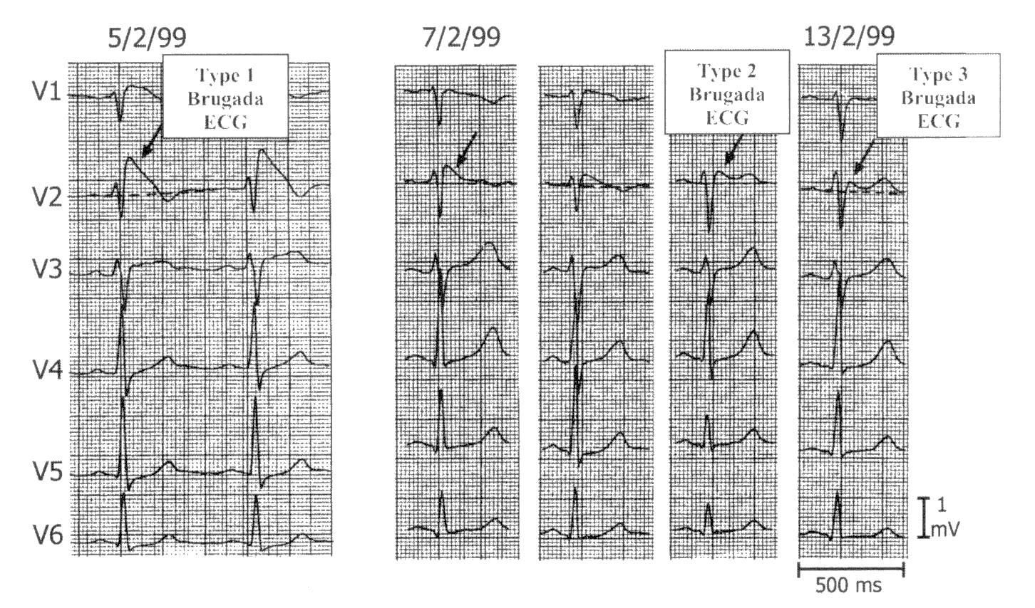 Hội chứng Brugada là gì? Nguyên nhân gây bệnh và nguyên tắc phòng ngừa