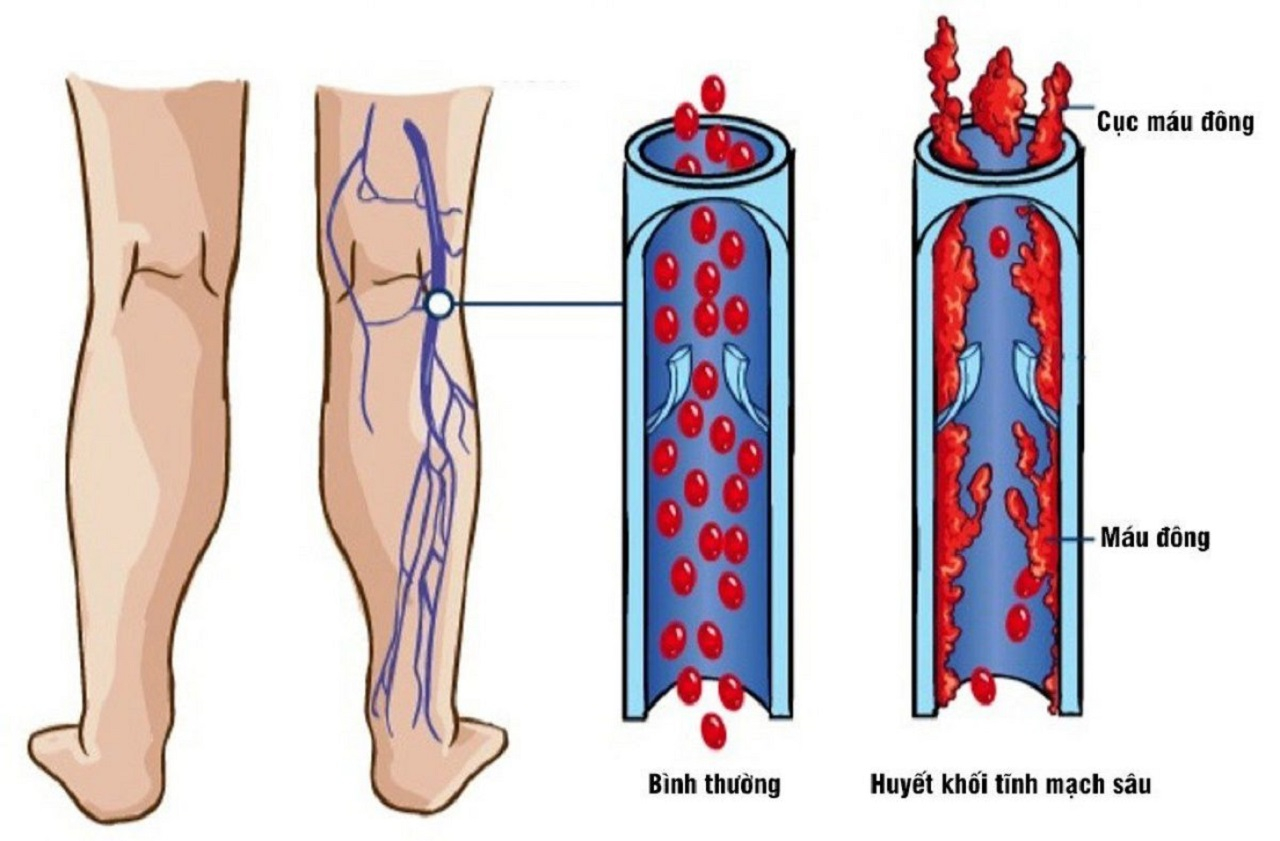 Huyết khối tĩnh mạch sâu