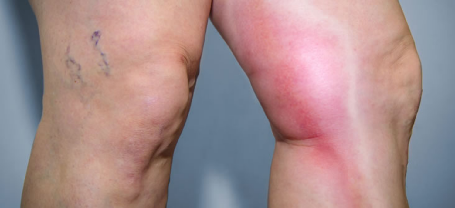 Huyết khối tĩnh mạch sâu