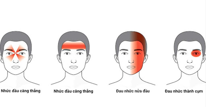 Nhức đầu
