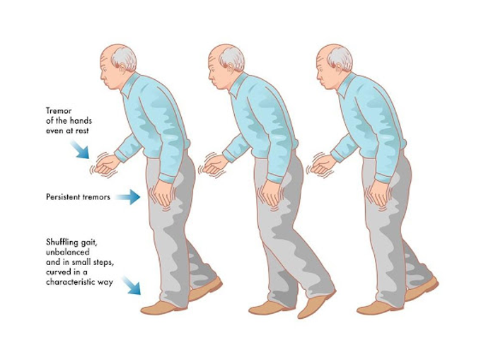 Parkinson