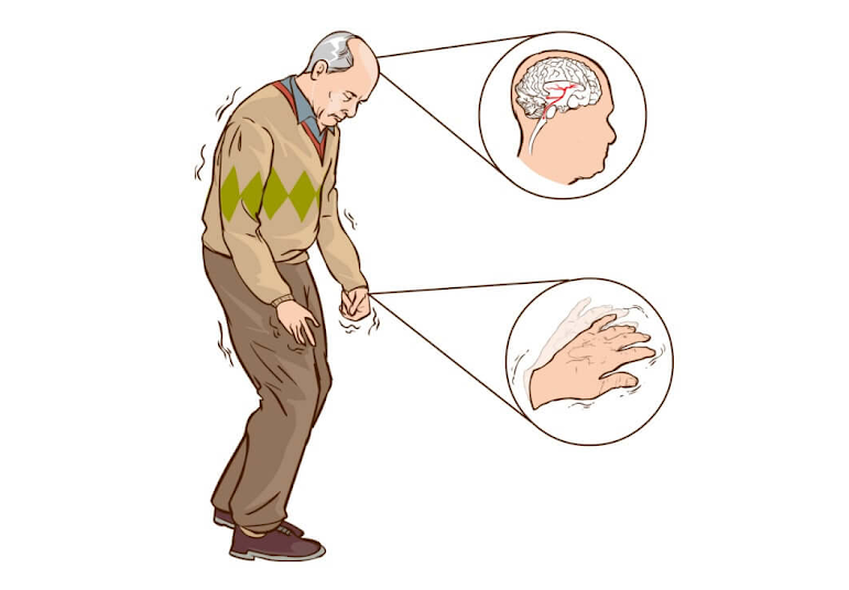 Parkinson thứ phát