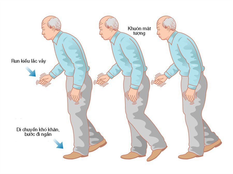 Parkinson thứ phát