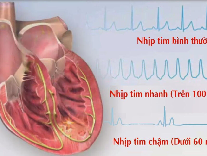 Nhịp tim chậm là gì? Nguyên nhân và cách điều trị nhịp tim chậm
