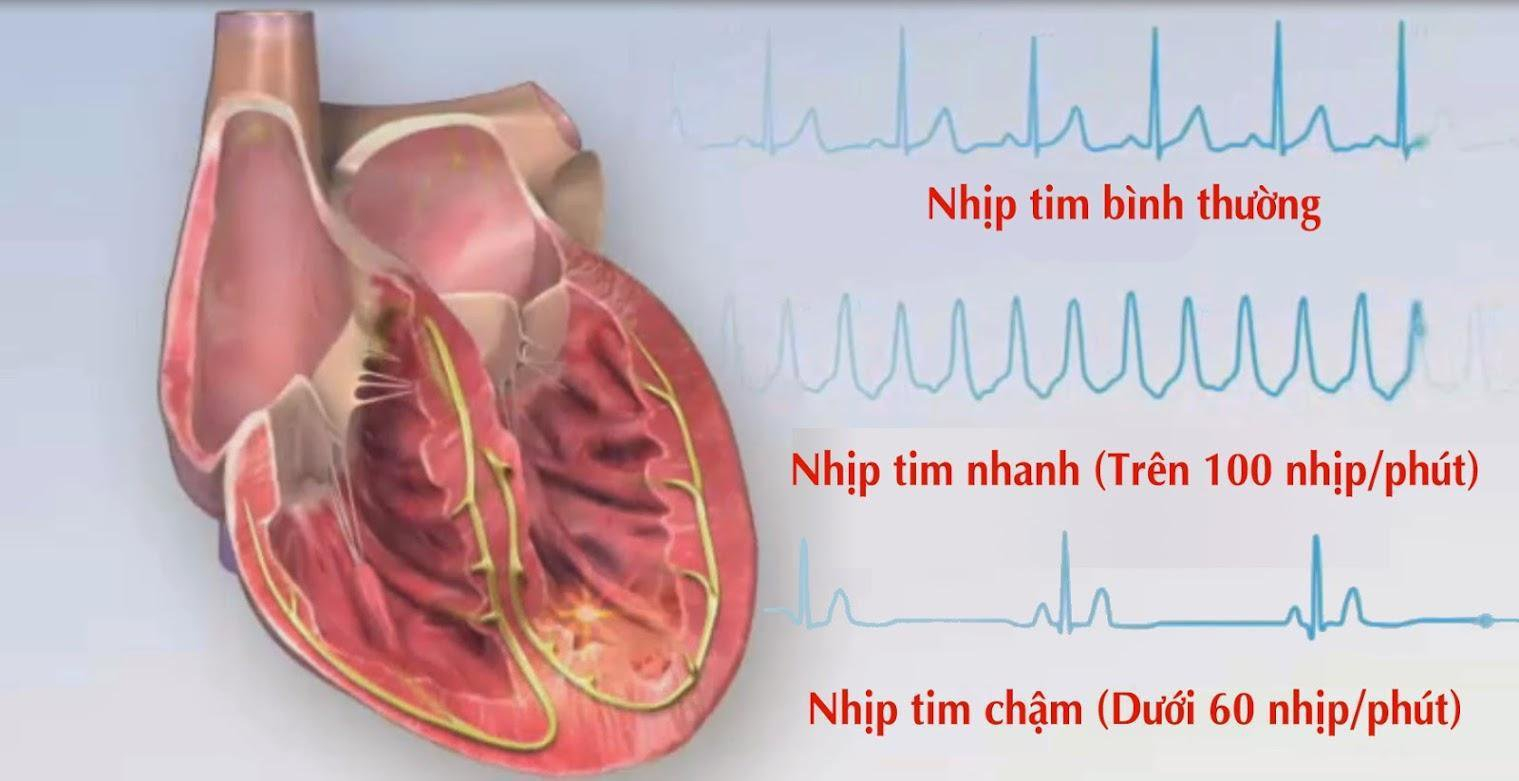 Nhịp tim chậm là gì? Nguyên nhân và cách điều trị nhịp tim chậm