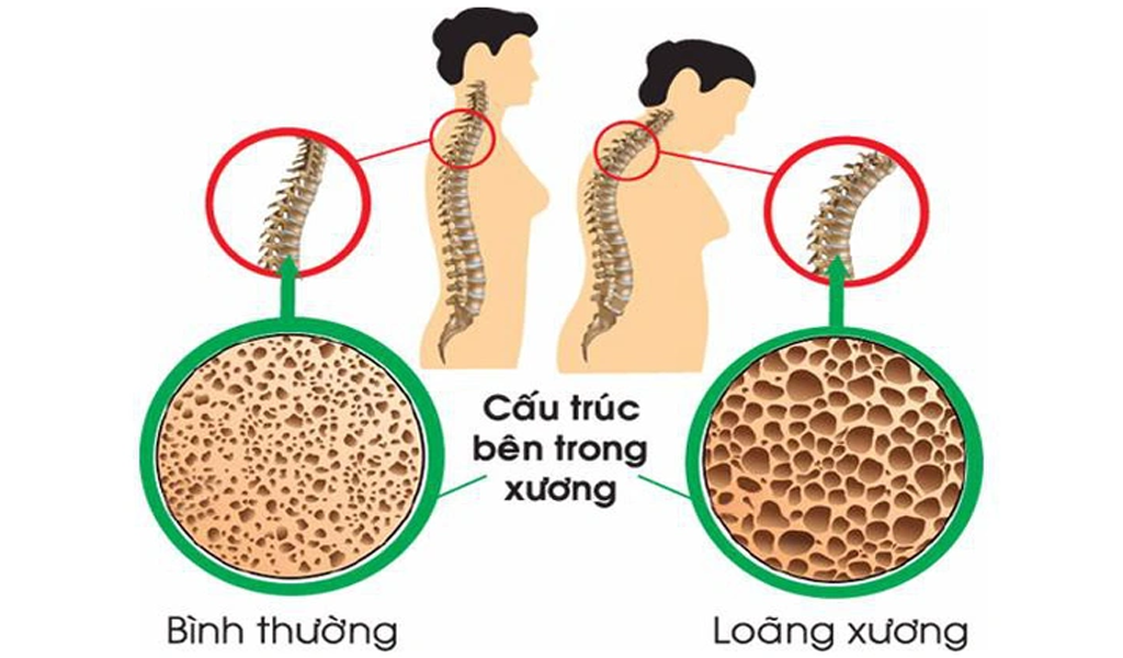 Thiếu canxi