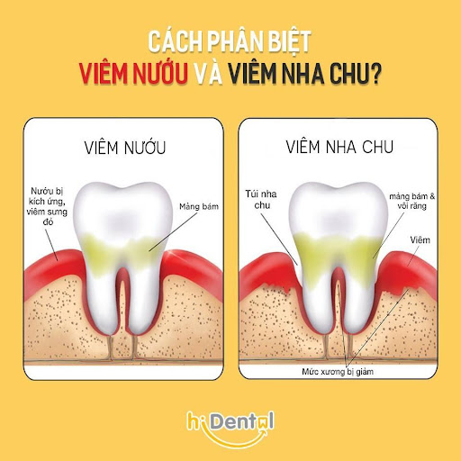 Bệnh nướu và nha chu