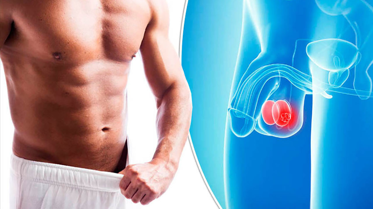 Ung thư tinh hoàn: Tế bào phát triển bất thường ở tinh hoàn của nam giới