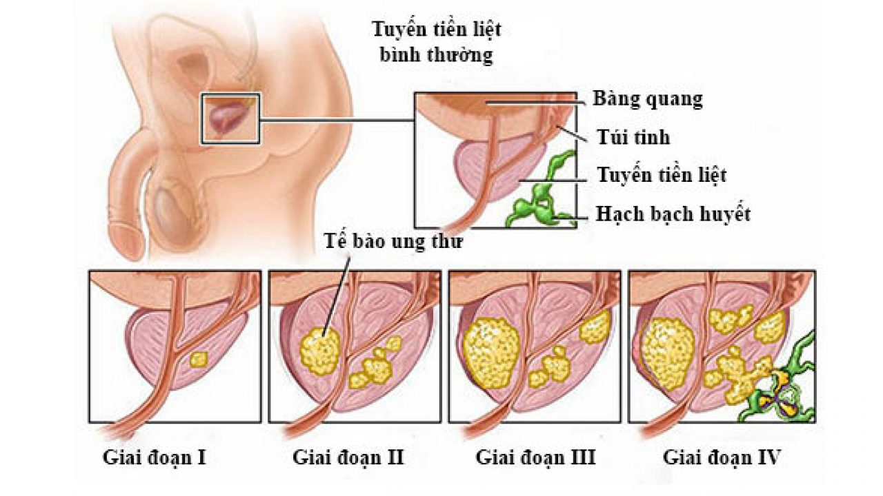 Ung thư tuyến tiền liệt