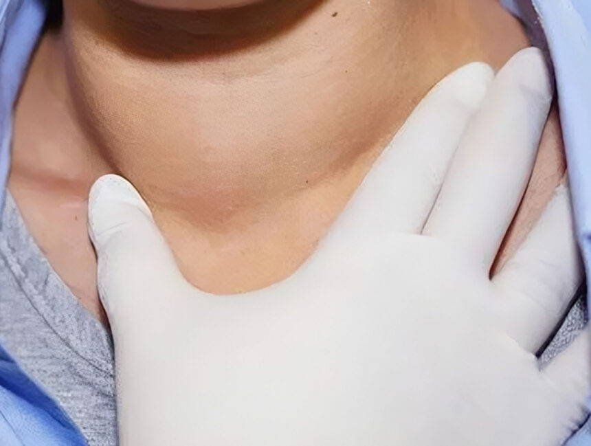 Ung thư vòm họng: Bệnh lý ác tính các tế bào niêm mạc vòm mũi họng