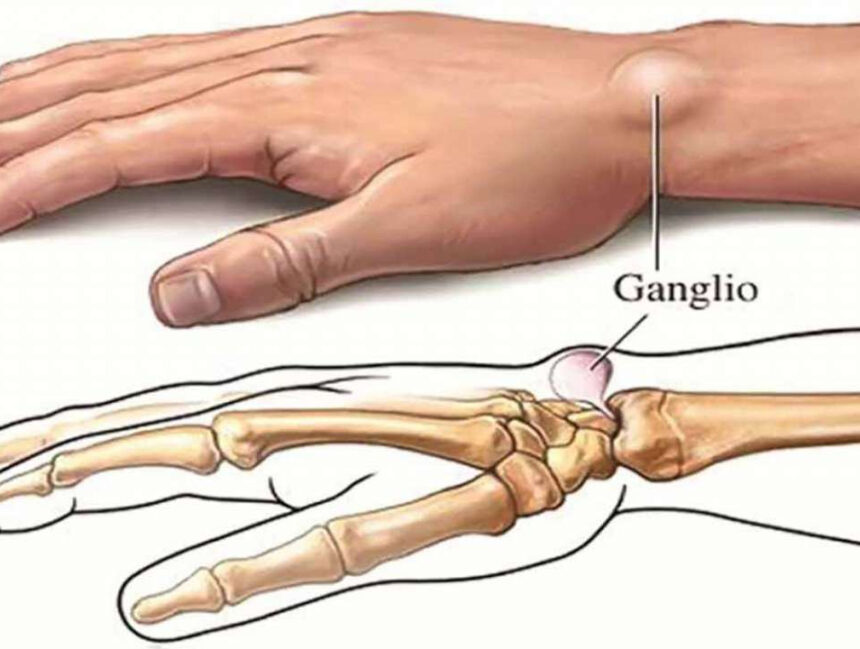 Ung thư xương là gì? Nguyên nhân và cách điều trị ung thư xương