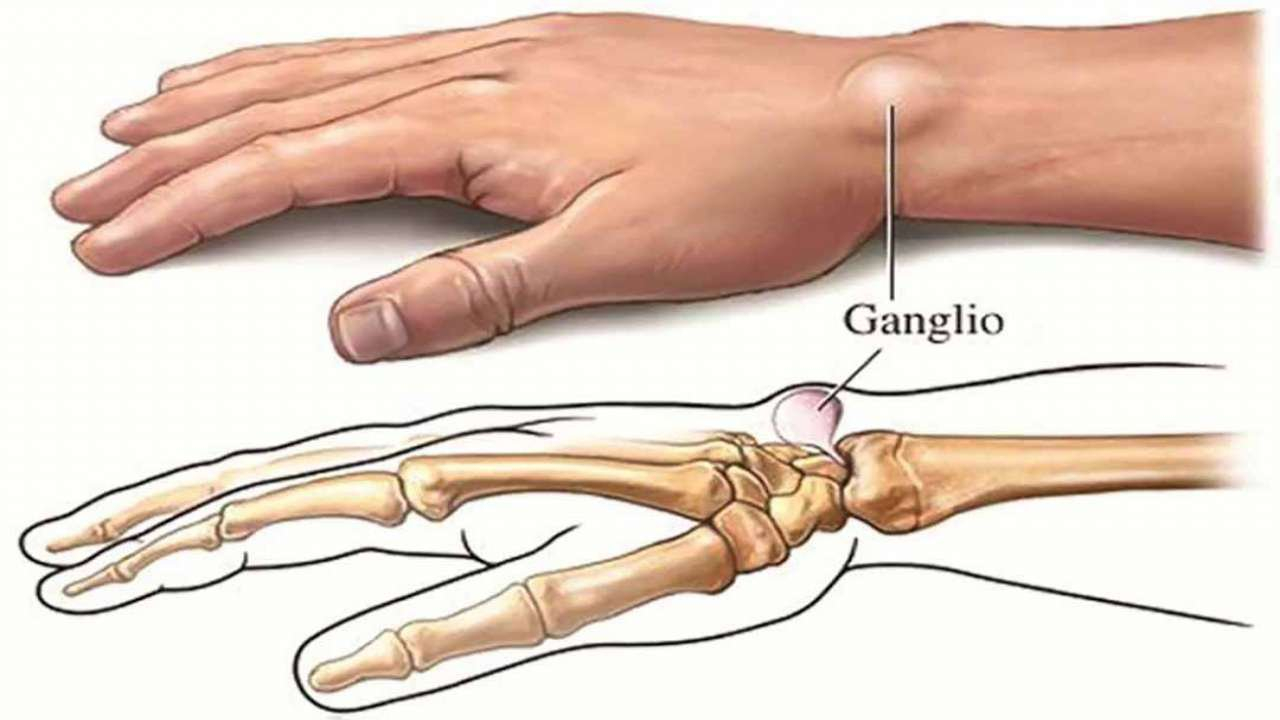 Ung thư xương là gì? Nguyên nhân và cách điều trị ung thư xương