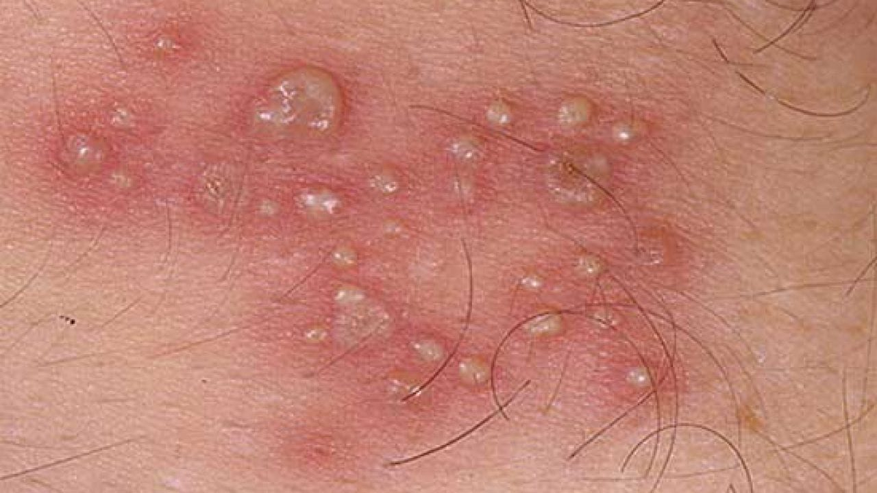 Herpes sinh dục