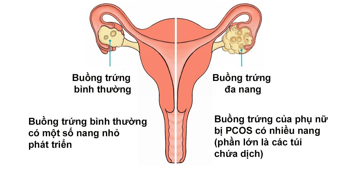 Hội chứng buồng trứng đa nang