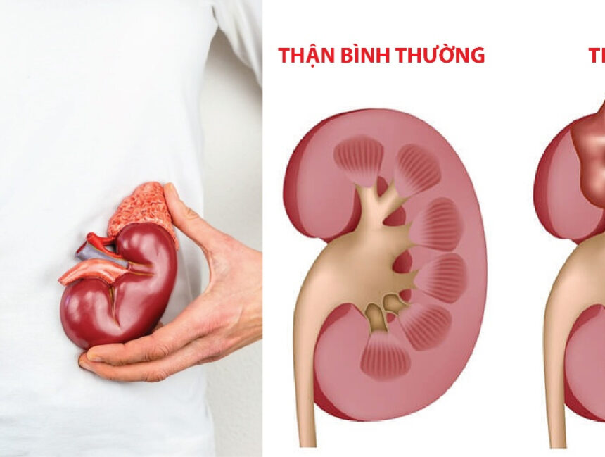 Hội chứng thận hư: Tình trạng cơ thể mất protein qua đường tiểu