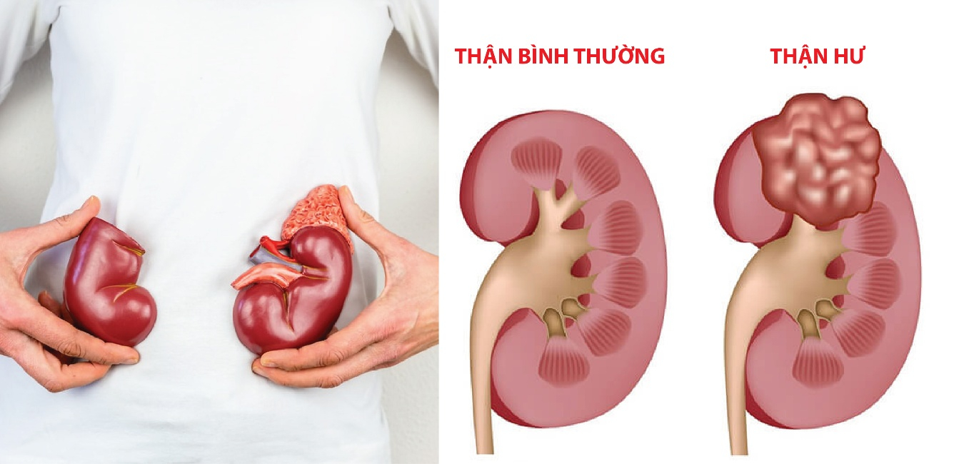 Hội chứng thận hư: Tình trạng cơ thể mất protein qua đường tiểu