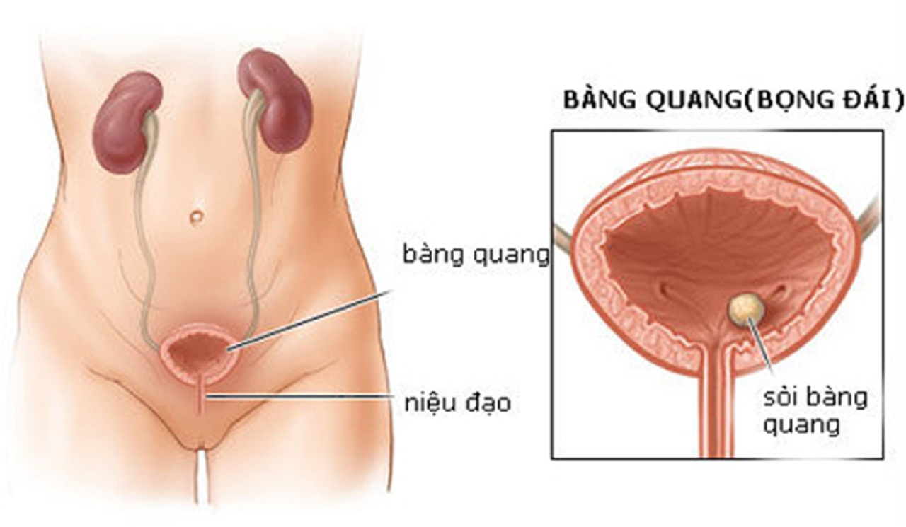 Sỏi bàng quang