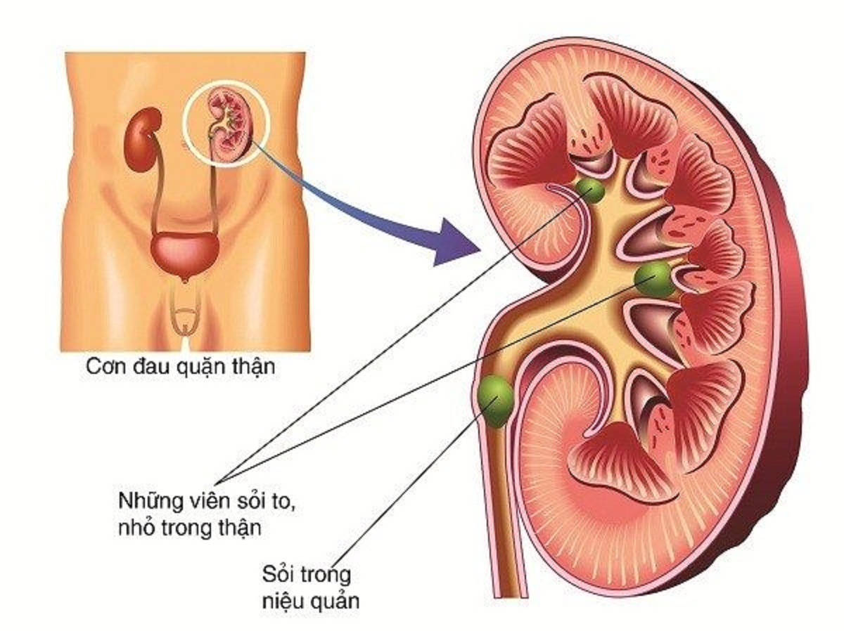 Sỏi tiết niệu