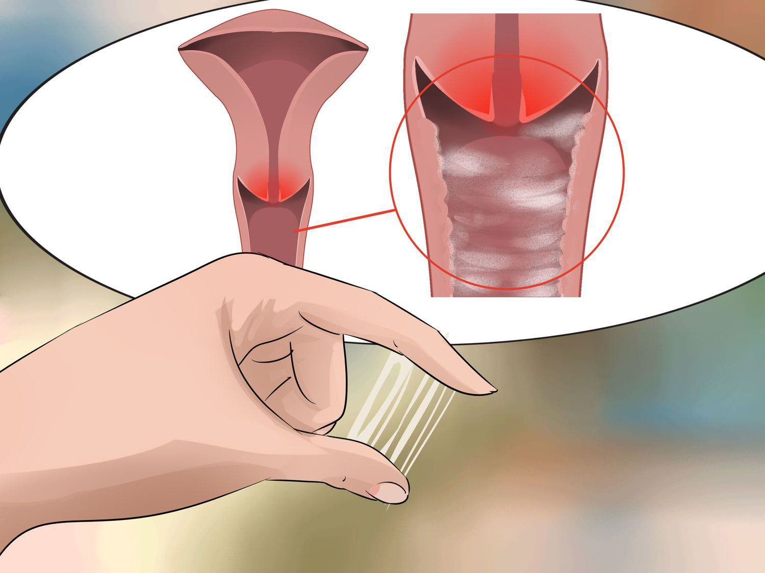 Huyết trắng do vi khuẩn