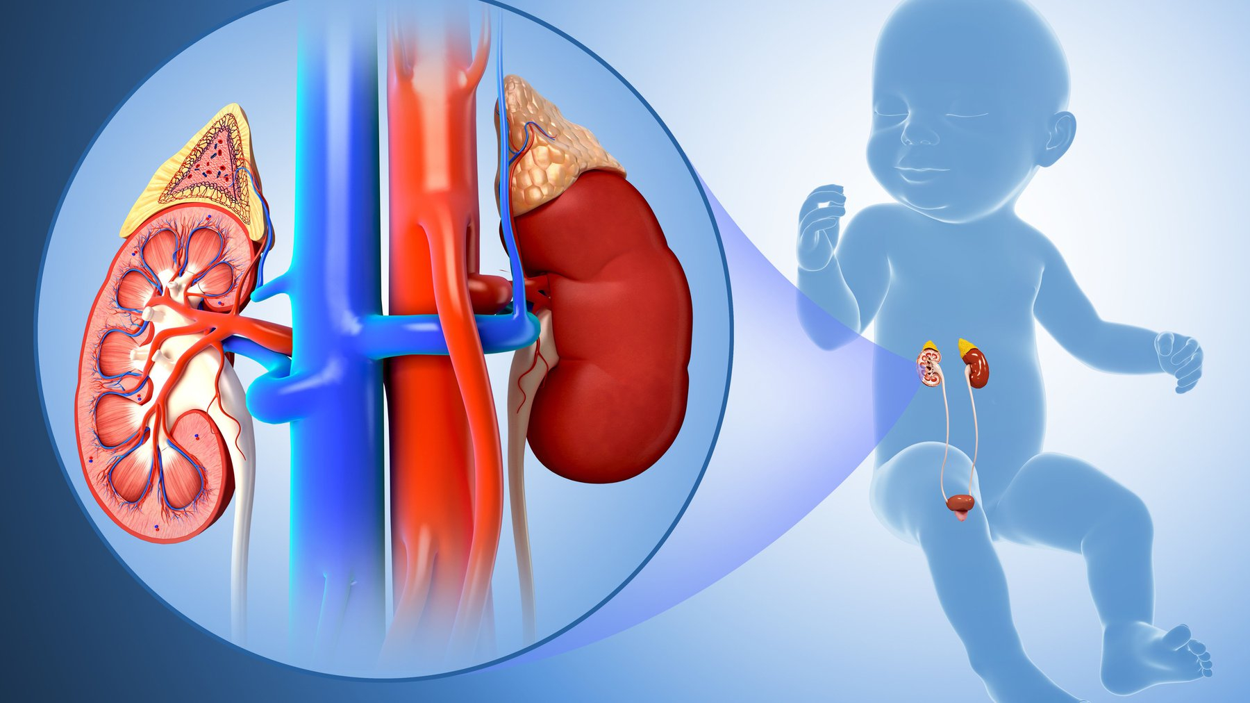 Viêm cầu thận cấp: Hội chứng viêm và tổn thương của các cầu thận