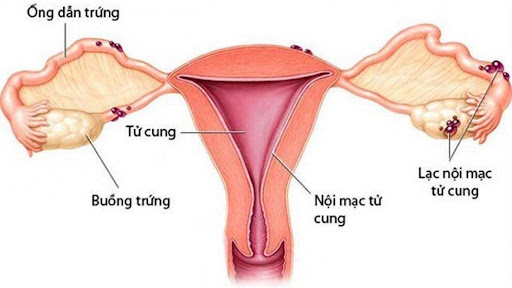 Lạc nội mạc tử cung