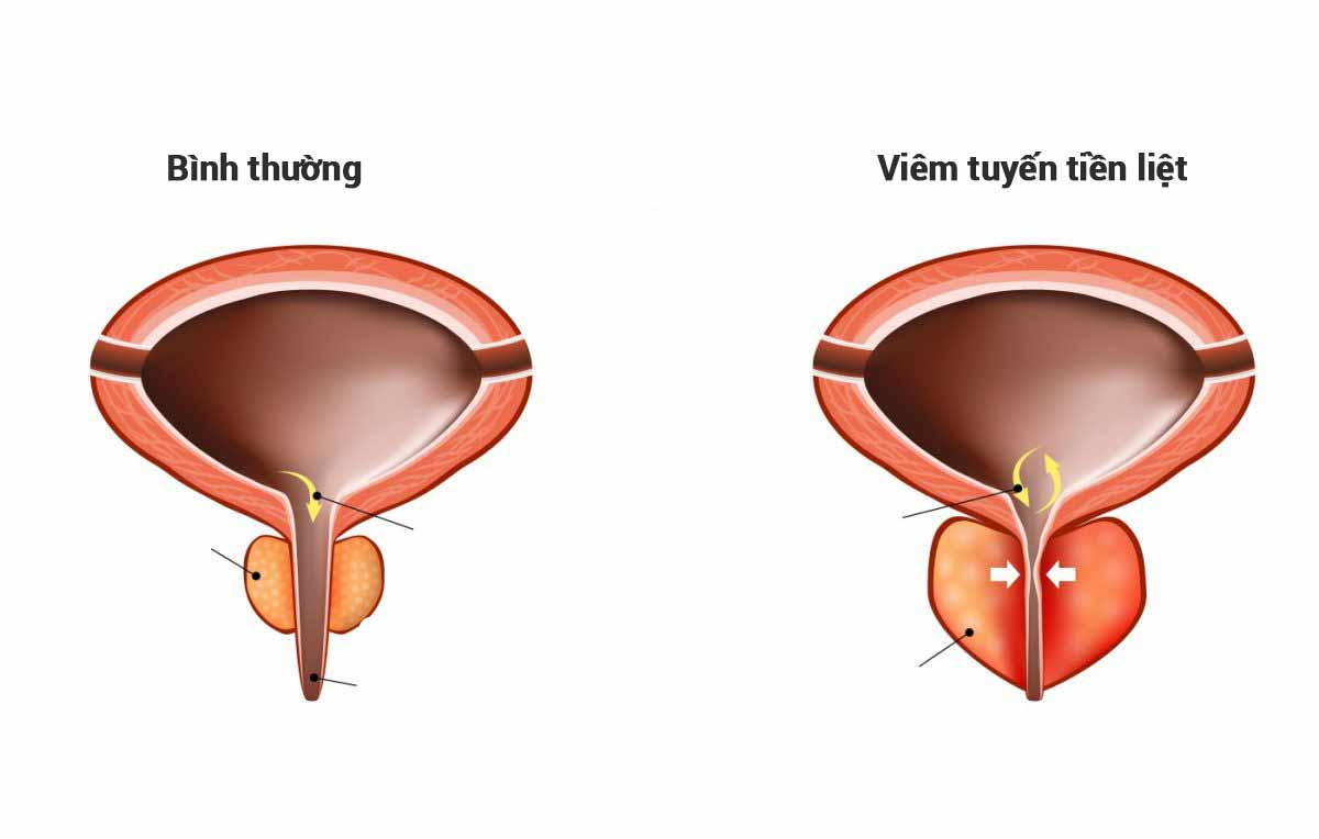 Viêm tuyến tiền liệt