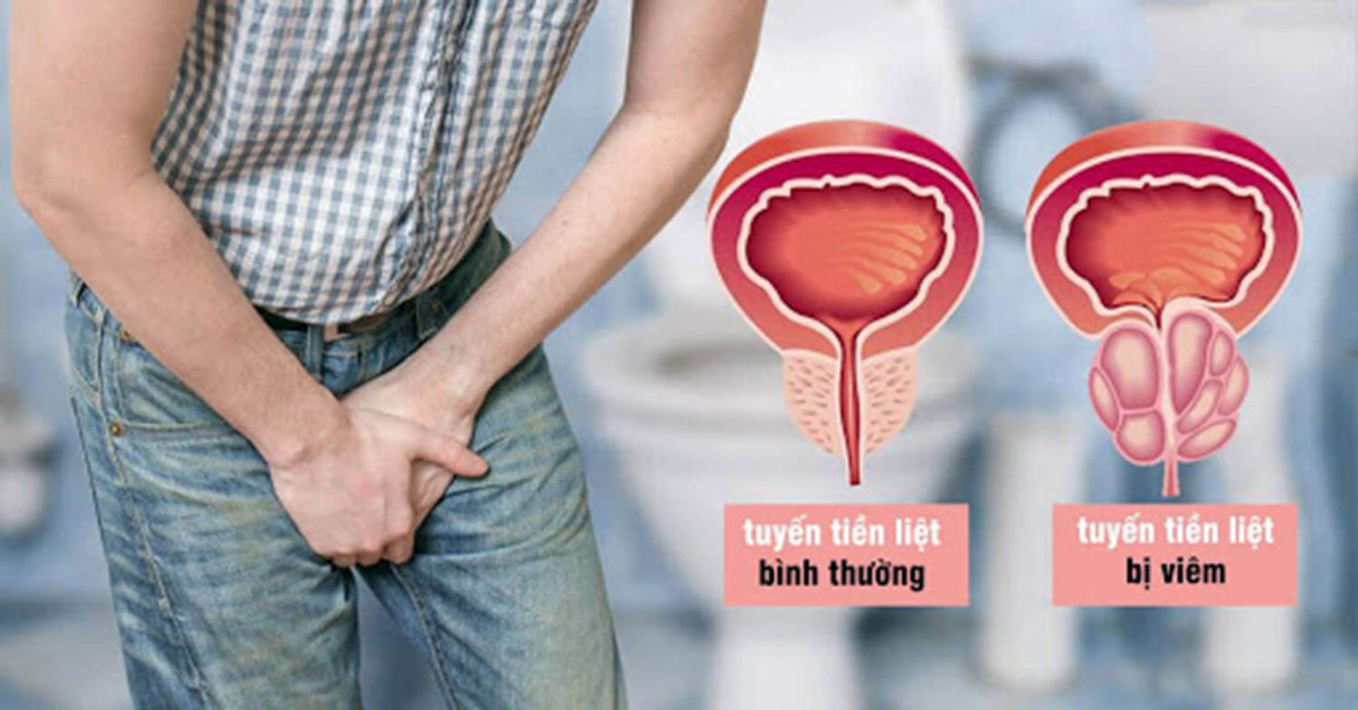Viêm tuyến tiền liệt ảnh hưởng sức khỏe nam giới như thế nào?