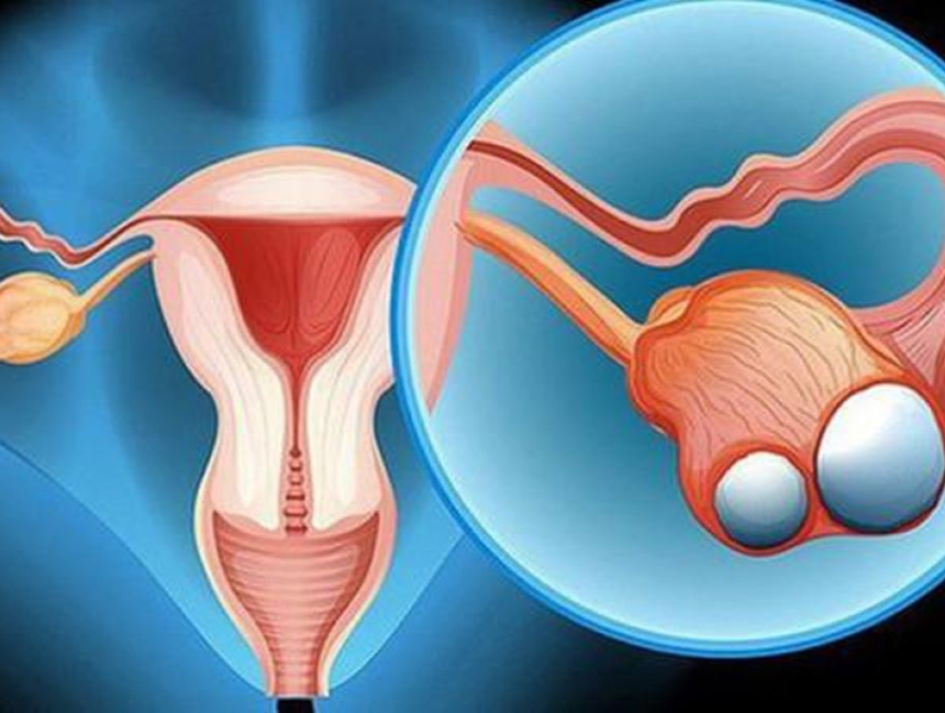 Ung thư buồng trứng: Nguyên nhân, triệu chứng, chẩn đoán và cách điều trị