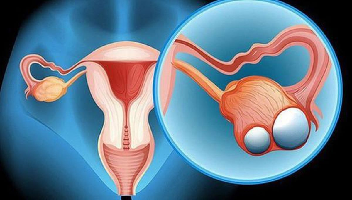 Ung thư buồng trứng: Nguyên nhân, triệu chứng, chẩn đoán và cách điều trị