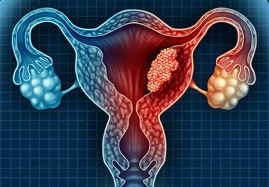 Ung thư cổ tử cung: Nguyên nhân, triệu chứng, chẩn đoán và điều trị