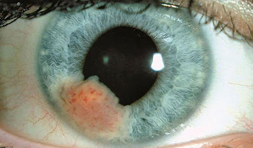 Ung thư mắt: Triệu chứng, nguyên nhân và cách điều trị