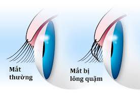 Lông quặm