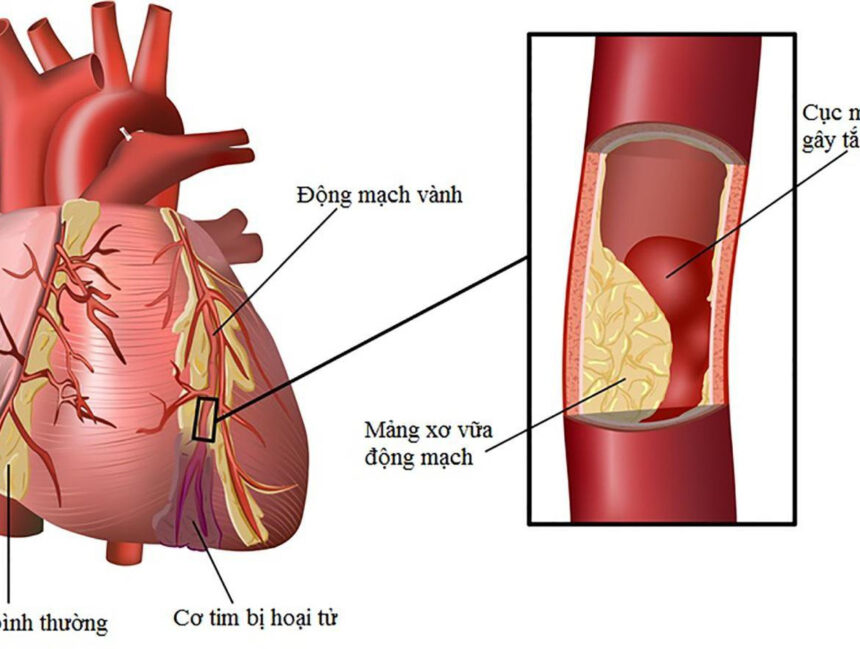 Thiếu máu cơ tim: Bệnh lý tim mạch nguy hiểm hàng đầu