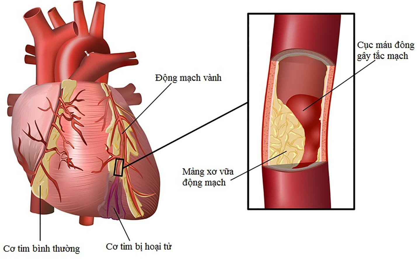 Thiếu máu cơ tim: Bệnh lý tim mạch nguy hiểm hàng đầu