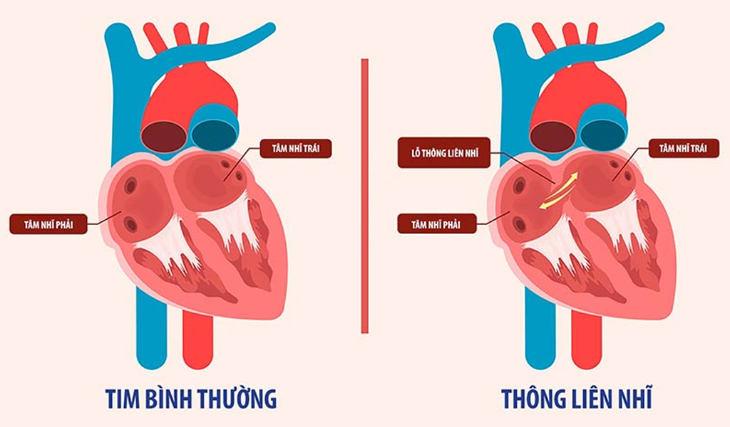 Thông liên nhĩ