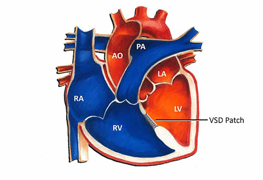 Thông liên thất