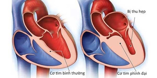 Viêm cơ tim