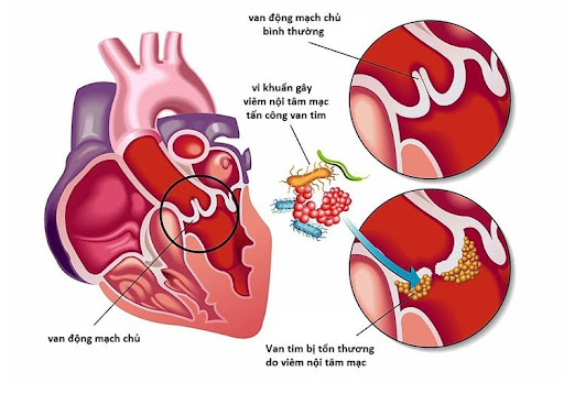 Viêm nội tâm mạc nhiễm khuẩn bán cấp