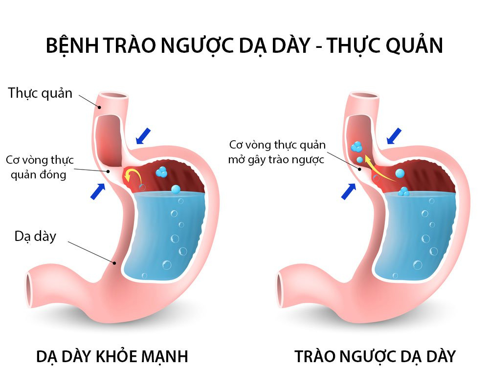 Barrett thực quản